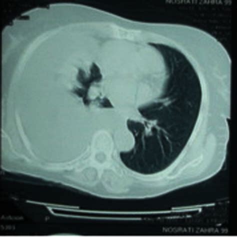 Chest Ct Scan Of The Patient Demonstrating Pleural Effusion Download