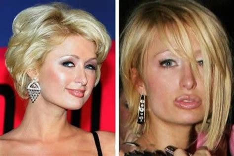 Plastic Surgery Gone Wrong Celebrities 12 Worst Plastic Surgery