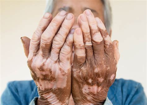 Vitiligo Causes And Treatments Dermatology Inc