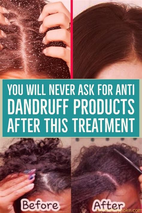 You Will Never Ask For Anti Dandruff Products After These 5 Natural
