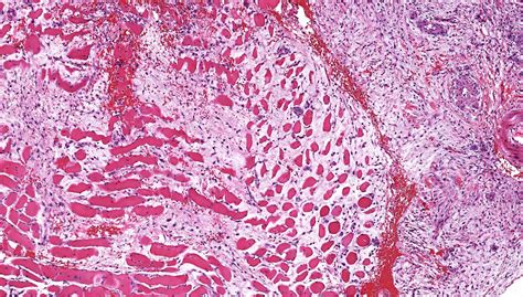 Pathology Outlines Myositis Ossificans And Fibro Osseous Pseudotumor