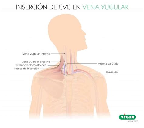 ¿cuál Es La Longitud Ideal Para Mi Catéter Venoso Central Campus Vygon