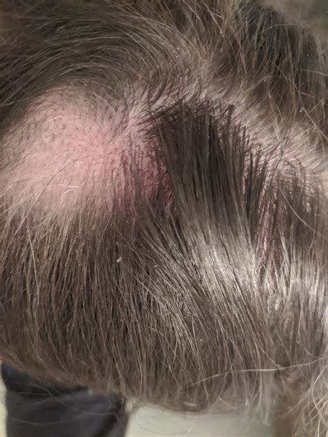 28 F With Red Scalp Where Hair Loss Is Occuring It Is A Bit Tender To
