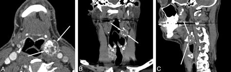 Osteoblastoma Of The Hyoid Bone American Journal Of Neuroradiology