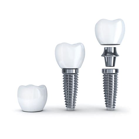 Dental Implants Best Dent