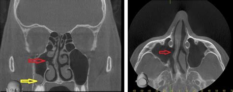 CBCT Paranasal Case Studies | Cavendish Imaging