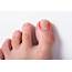 What Should You Expect From Ingrown Toenail Surgery  Foot & Ankle