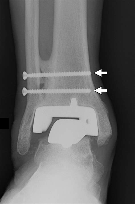Current Concepts In Total Ankle Replacement For Radiologists Features
