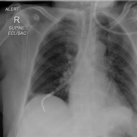 Dobhoff Tube Placement X Ray 2 Get A Cxr Not An Abdominal Xray