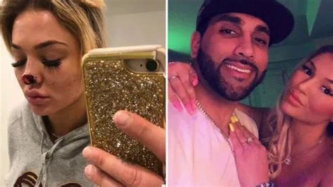 Instagram Model Gets Nose Bitten Off By Jealous Boyfriend Youtube