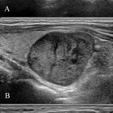 The Typical Ultrasound Presentation Of Parathyroid Neoplasm A