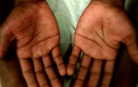 Case A 16 Year Old Male Complains Of A Rash On Both Hands And Feet