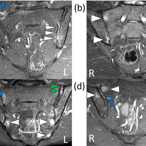 Structural Changes On Mri Of The Sacroiliac Joints Of Psa Patients