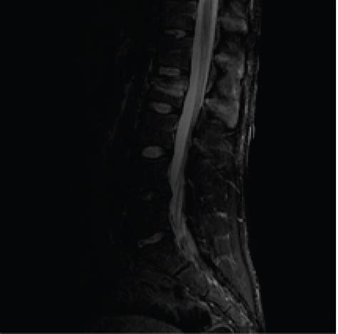 Mri Lumbar Spine Fracture Dislocation Mri Magnetic Resonance Imaging