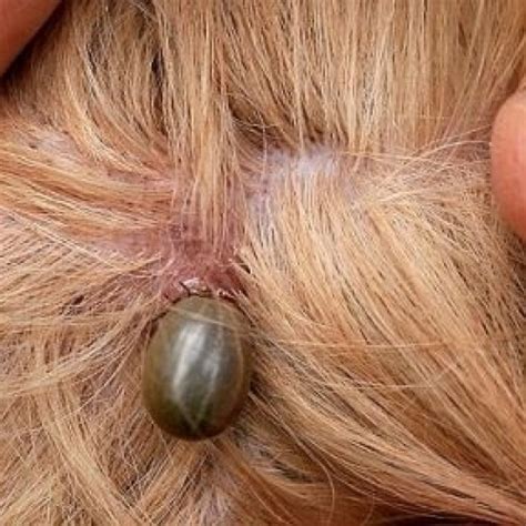 Maybe you would like to learn more about one of these? What Ridgefield Needs To Know About Deer Ticks