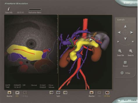 Radial Endoscopic Ultrasonography Image And Anatomical 3 Dimensional
