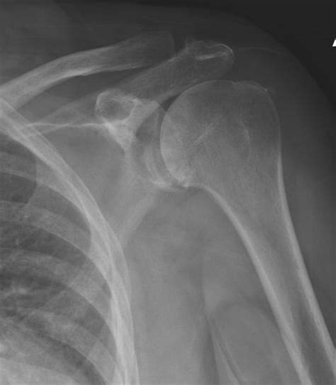 Inflammatory Arthropathies Of The Shoulder The Clinical Advisor