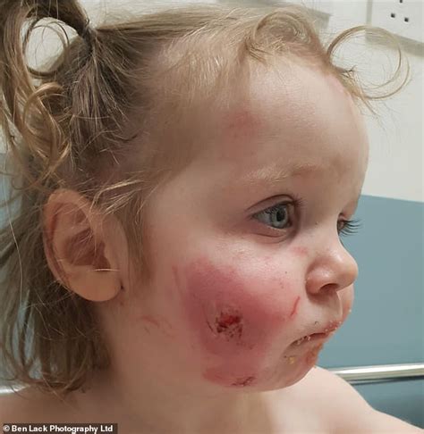 Toddler Bitten 15 Times By Children At Soft Play Centre In Seacroft