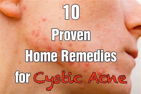 Basic Skin Care Tips That Everyone Should Be Using Cystic Acne