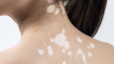 Vitiligo And Loss Of Skin Color Overview Lông Mi Lông Mày