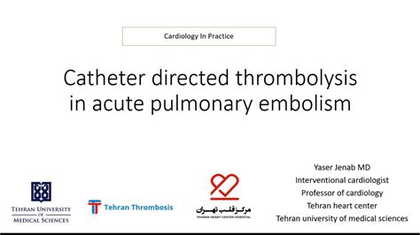 catheter directed thrombolysis cdt in acute pulmonary embolism youtube