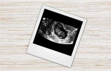 7 Week Pregnancy Ultrasound What To Expect Lovetoknow Health And Wellness