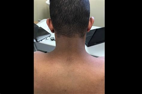 Image Of The Week Discolored Plaques On The Neck And Axillae