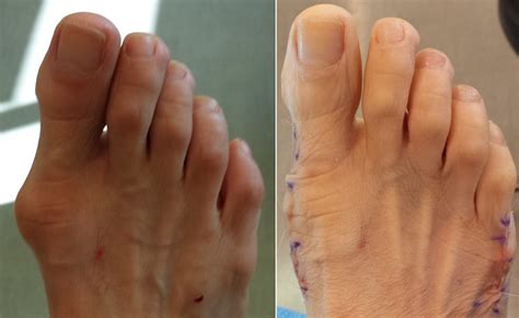 Bunion Doctor In Orange County Oc Podiatry