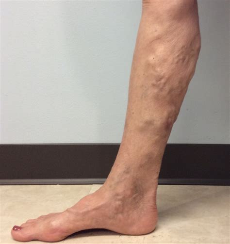 Venous Insufficiency Pictures Images A Visual Guide