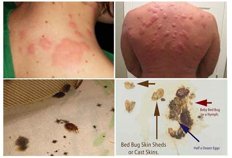 Treatment Bed Bug Bite Symptoms Bed Decor