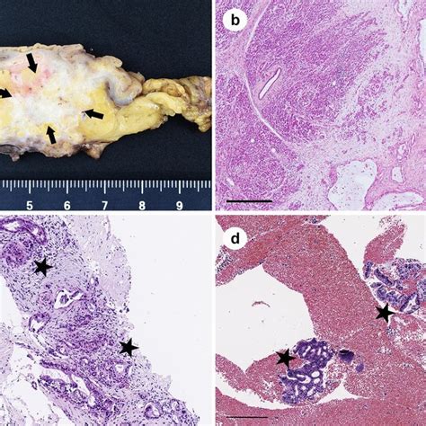 Histology Of Pancreatic Ductal Adenocarcinoma Pdac A Representative