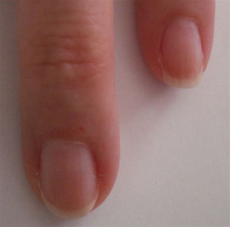 Abnormal Fingernail Beds Following Carbon Monoxide Poisoning A Case