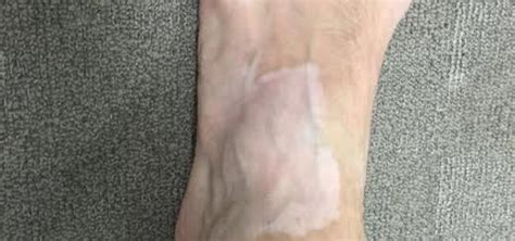 Liver Spots On Feet And Ankles