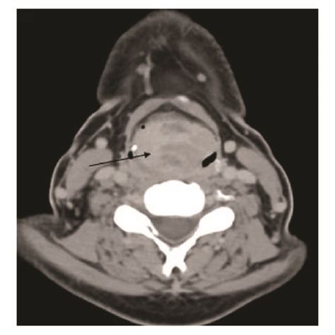 A Plain Ct Scan Of The Neck Showing Soft Tissue Mass At The Region Of