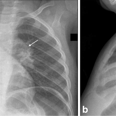 Anteroposterior A And Lateral B Chest Radiographs In A