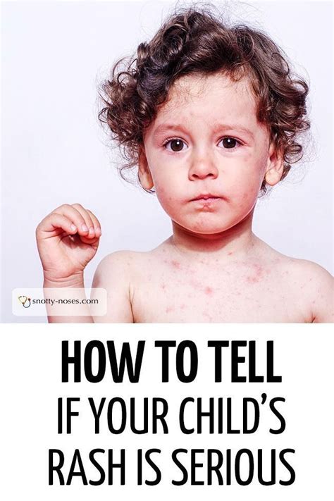Spotty Child How To Tell If Your Childs Rash Is Serious A Great