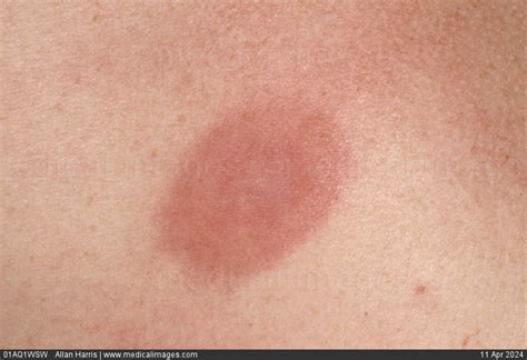 Stock Image Dermatology Mosquito Bite A Raised Oval Shaped Patch Witha