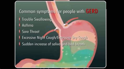 You can prevent or relieve your symptoms from gastroesophageal reflux (ger) or gastroesophageal reflux disease (gerd) by changing your diet. GERD: Gastro Esophageal Reflux Disease Causes and ...