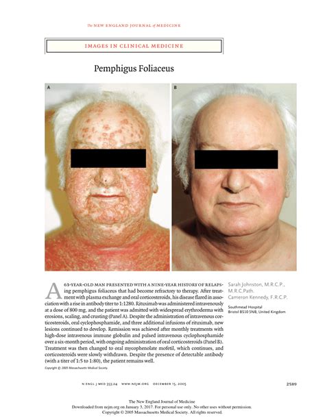 Pdf Images In Clinical Medicine Pemphigus Foliaceus