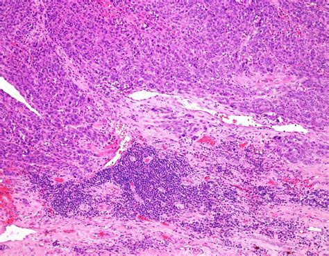 Melanoma Tumor Infiltrating Lymphocytes Light Micrograph Stock Image