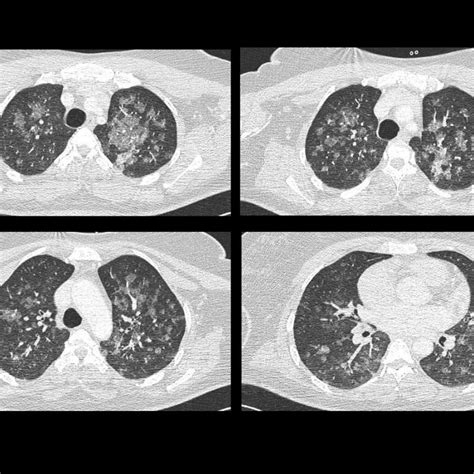 Chest Ct Scan Depicting Bilateral Ground Glass Opacities Following