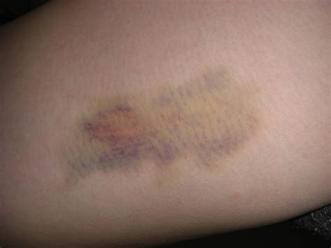 Thigh Bruise Location Right Inner Thigh Date Of Acquisiti Flickr