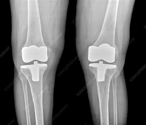 Bilateral Total Knee Replacement X Ray Stock Image C0041483