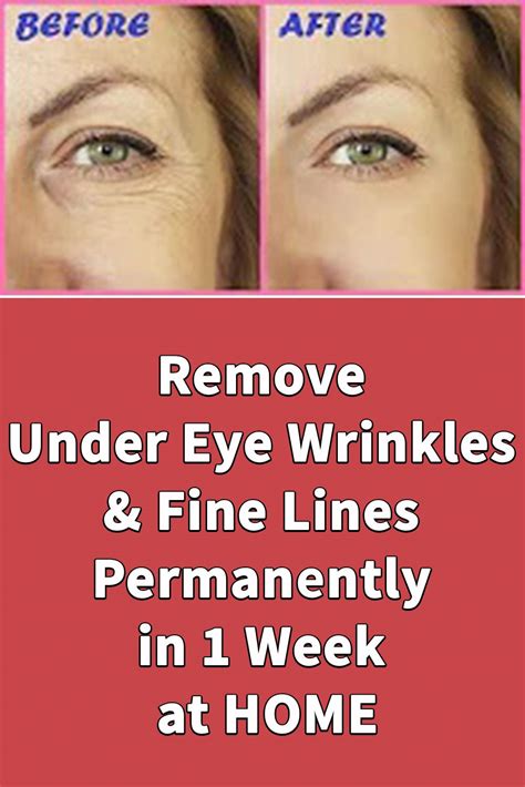 Remove Under Eye Wrinkles And Fine Lines Permanently In 1 Week At Home In