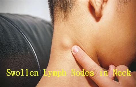 Swollen Lymph Nodes In Neck Causes And Treatment