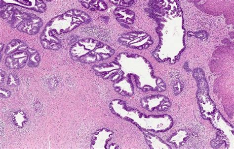Pathology Outlines Hpv Associated Adenocarcinoma Usual Type And