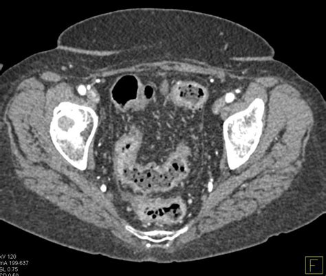 Perforated Gallbladder With A Large Abscess Gastrointestinal Case