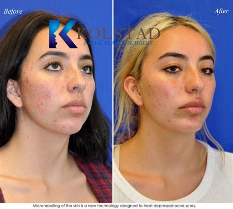 Acne Scar Treatment San Diego 10 Dr Kolstad San Diego Facial