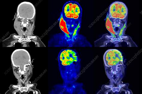 Diffuse Large B Cell Lymphoma Ct And Pet Scan Stock Image C054