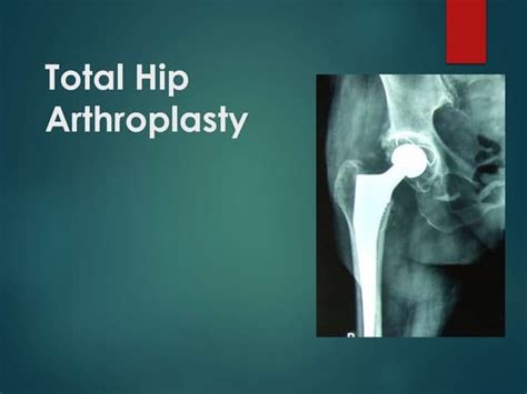 Total Hip Arthroplasty Ppt